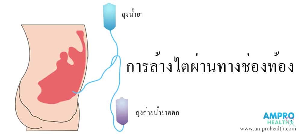 วิธีการบำบัดทดแทนไต (Kidney Replacement Therapy) วิธีการบำบัดทดแทนไต (Kidney Replacement Therapy)