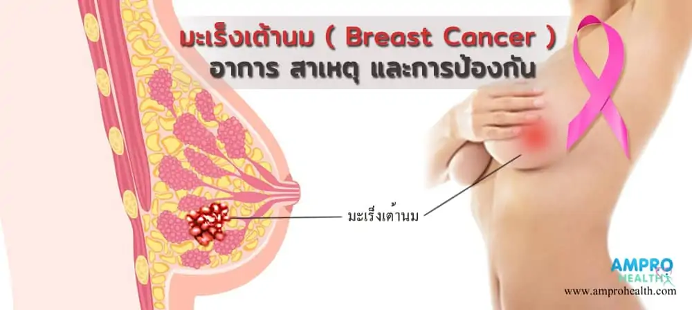 มะเร็งเต้านม ( Breast Cancer ) อาการ สาเหตุ และการป้องกัน