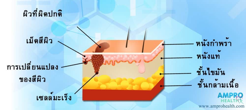 โรคมะเร็งผิวหนัง (Skin Cancer)