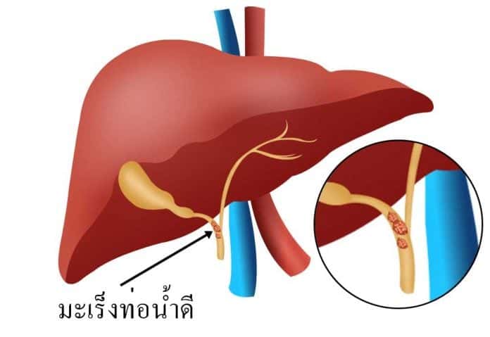 โรคมะเร็งท่อน้ำดี (Cholangiocarcinoma, CCA) คืออะไร