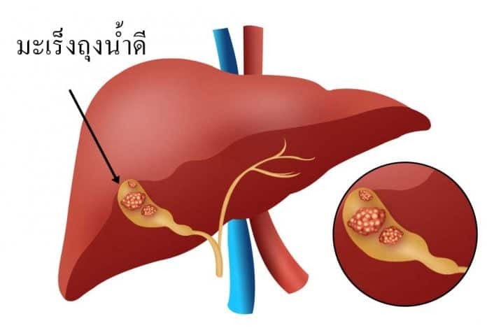 โรคมะเร็งถุงน้ำดี (Gallbladder Cancer)