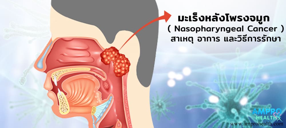 มะเร็งหลังโพรงจมูก ( Nasopharyngeal Cancer )