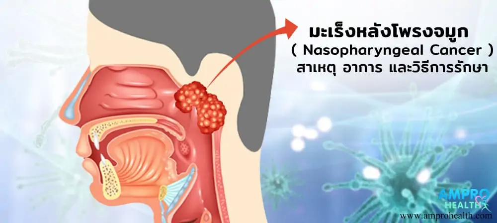 มะเร็งหลังโพรงจมูก ( Nasopharyngeal Cancer )