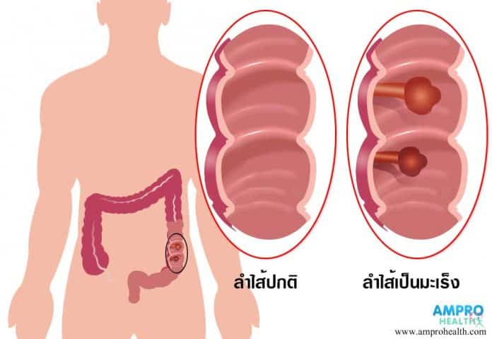 โรคมะเร็งลำไส้โดยเกิดก้อนเนื้อเล็กๆในลำไส้ จะเกิดขึ้นตั้งแต่บริเวณลำไส้เล็กจนถึงปลายทวานหนัก