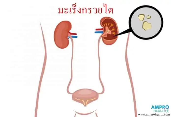 โรคมะเร็งกรวยไตและมะเร็งท่อไต