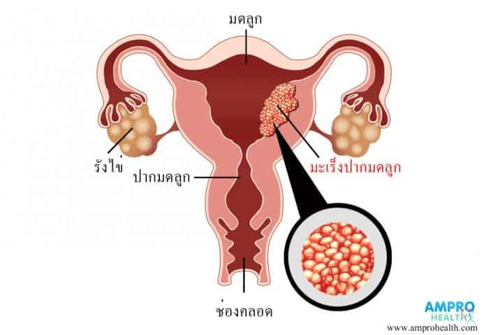 โรคมะเร็งซาร์โคมามดลูก สาเหตุ อาการเบื้องต้นและวิธีการรักษา