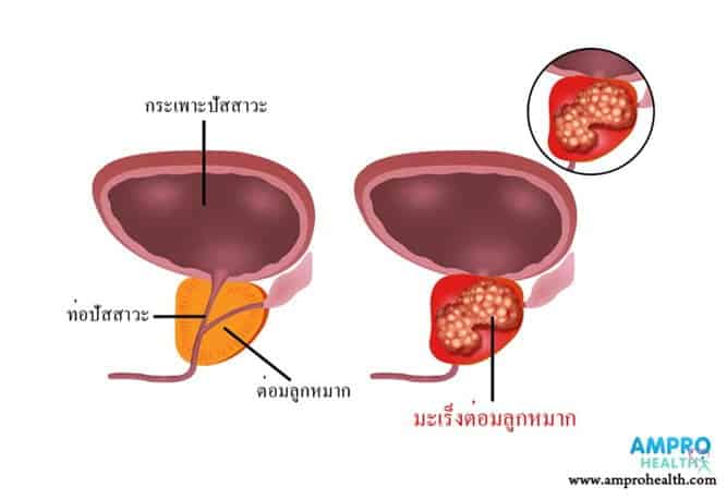 โรคมะเร็งต่อมลูกหมาก (Prostate Cancer)