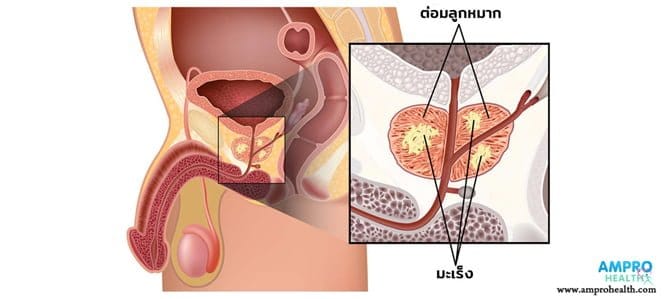 โรคมะเร็งต่อมลูกหมาก (Prostate Cancer)