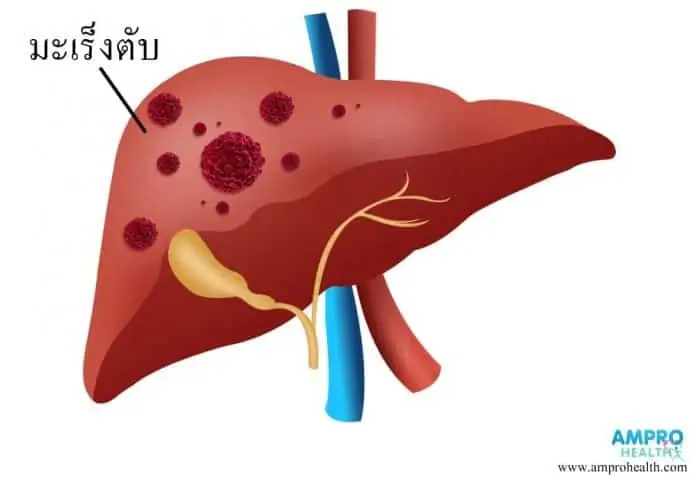 โรคมะเร็งตับ (Liver Cancer)