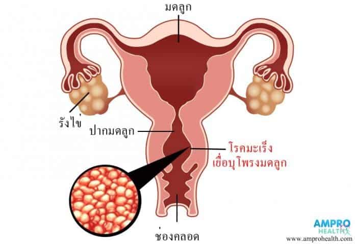 สาเหตุ อาการและวิธีการรักษาโรคมะเร็งเยื่อบุโพรงมดลูก (Endometrial Cancer)