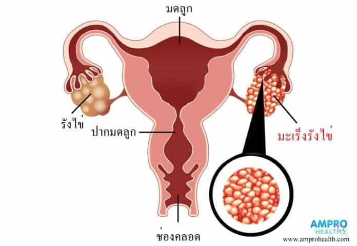 สาเหตุ อาการ วิธีรักษาโรคมะเร็งรังไข่ (Ovarian Cancer)