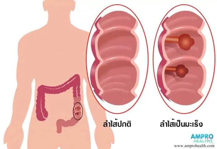 โรคมะเร็งลำไส้ใหญ่ สาเหตุ อาการ วิธีรักษาโรคมะเร็งลำไส้ใหญ่ (Colorectal Cancer)