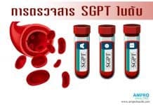 Serum Glutamic Pyruvate Transaminase (SGPT) คืออะไร? ค่าตับที่ควรรู้ การตรวจสาร SGPT (เอส จี พี ที) ในตับ
