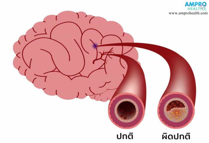 โรคหลอดเลือดสมอง สาเหตุ อาการ และวิธีการรักษา (Stroke)