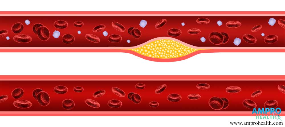 ไตรกลีเซอไรด์ (Triglyceride) คืออะไร? ไตรกลีเซอไรด์ (Triglyceride) คืออะไร?