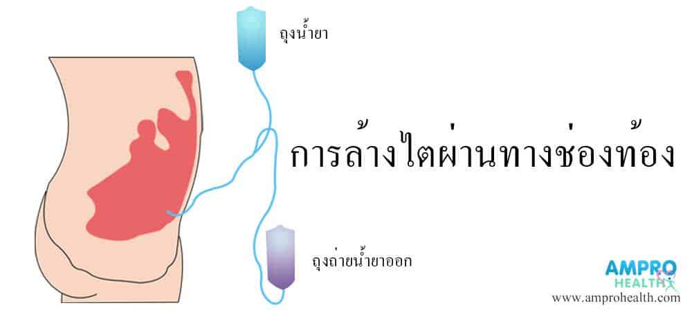 วิธีการบำบัดทดแทนไต (Kidney Replacement Therapy)