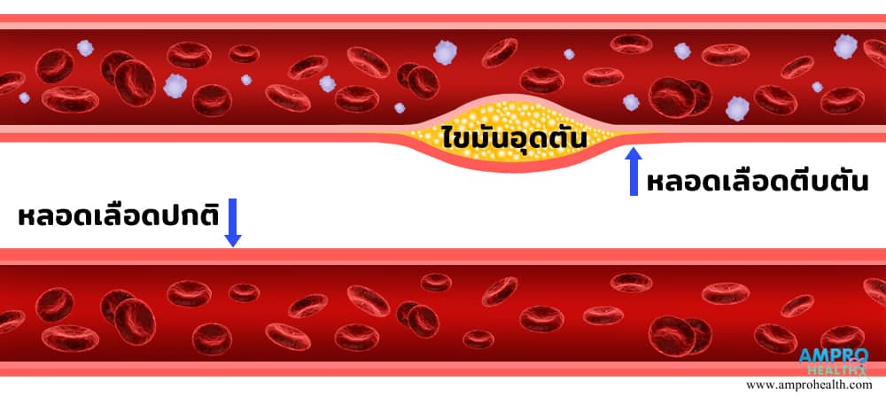 ไตรกลีเซอไรด์ (Triglyceride) คืออะไร?