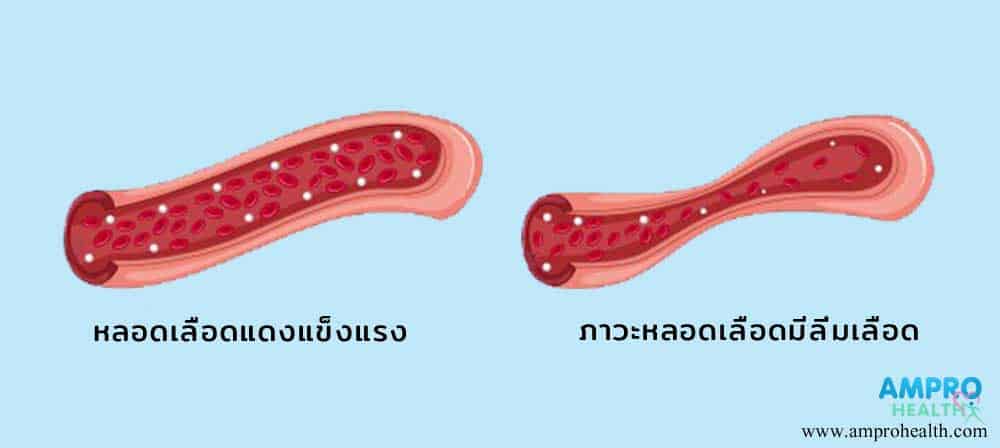 กล้ามเนื้อหัวใจตาย เสี้ยวนาทีแห่งชีวิต