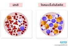 มะเร็งเม็ดเลือดขาว ( Leukemia )  โรคมะเร็งเม็ดเลือดขาว (Leukemia)