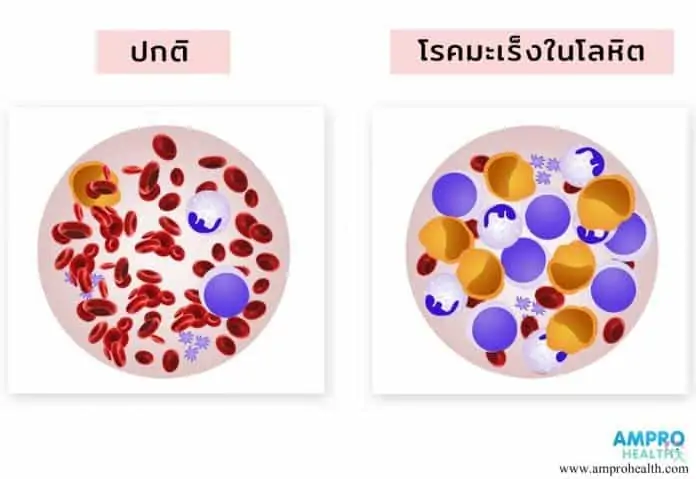 โรคมะเร็งเม็ดเลือดขาว (Leukemia)