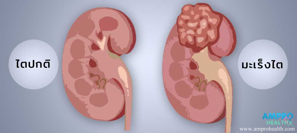 อาการ สาเหตุและวิธีการรักษาโรคมะเร็งไต (Kidney Cancer)