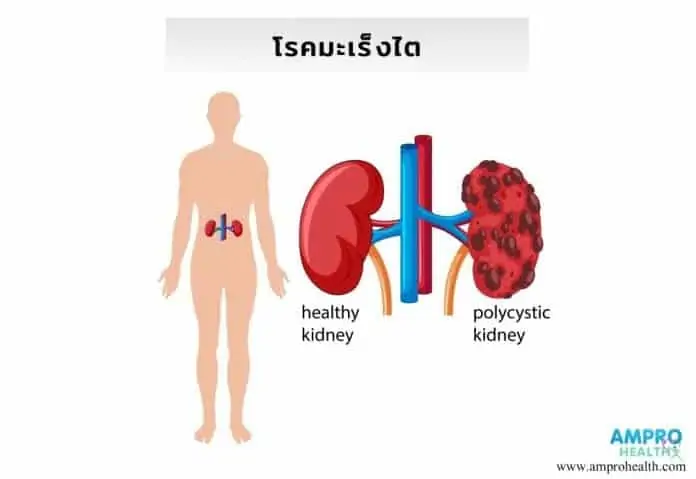 อาการ สาเหตุและวิธีการรักษาโรคมะเร็งไต (Kidney Cancer)