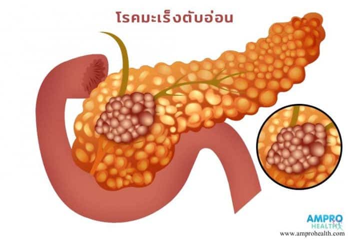 โรคมะเร็งตับอ่อน (Pancreatic Cancer)