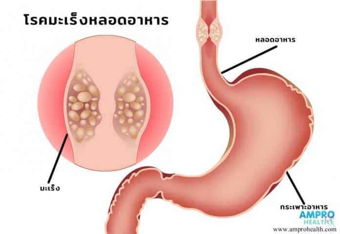สาเหตุและอาการของโรคมะเร็งหลอดอาหาร (Esophageal Cancer)