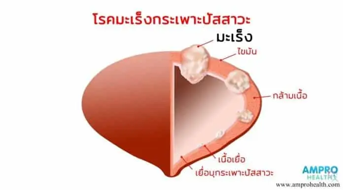 โรคมะเร็งกระเพาะปัสสาวะ (Urinary Bladder Cancer)