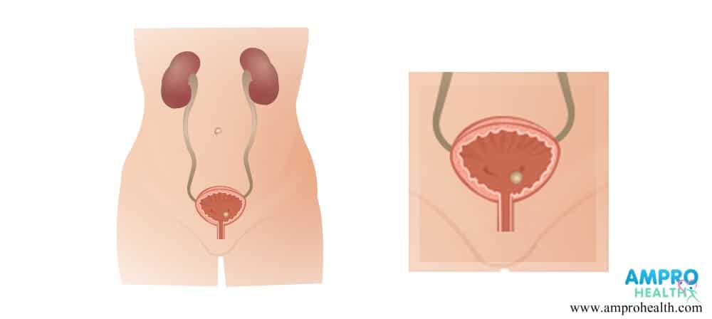 โรคมะเร็งกระเพาะปัสสาวะ (Urinary Bladder Cancer)