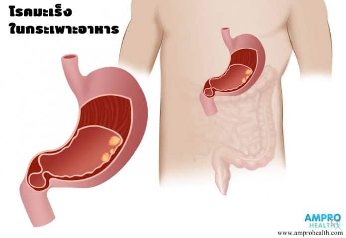 โรคมะเร็งกระเพาะอาหาร (Gastric Cancer)