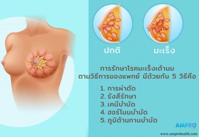 มะเร็งเต้านม ( Breast Cancer ) อาการ สาเหตุ และการป้องกัน