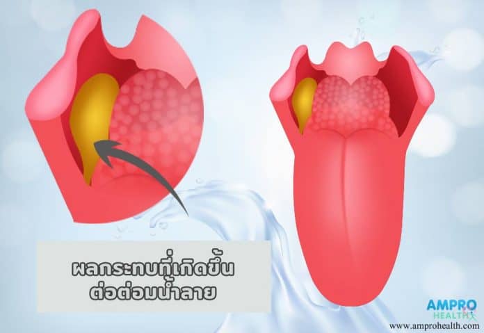 ผลข้างเคียงจากการฉายแสงรักษามะเร็งศีรษะ และ มะเร็งลำคอ