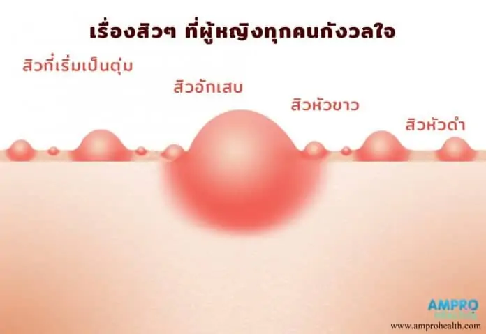 สิวเรื่องที่ผู้หญิงทุกคนกังวลใจ