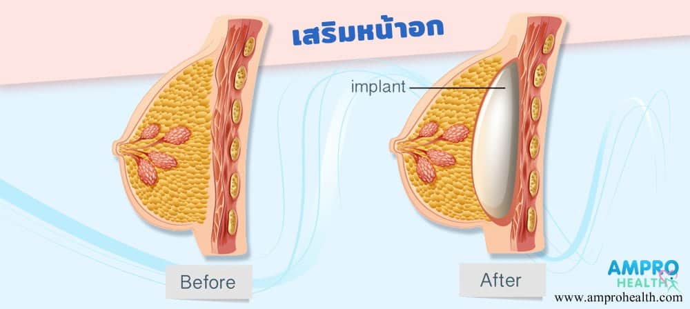 เสริมหน้าอก ทรงไหนดี ทรงซิลิโคน มีข้อดีข้อเสีย อย่างไรบ้าง