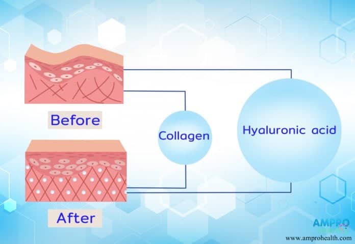 Hyaluronic acid (กรดไฮยาลูโรนิค) คืออะไรเกี่ยวอะไรกับ ฟิลเลอร์