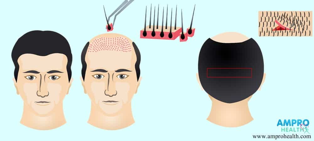 การปลูกผมแบบ Follicular Unit Transplantation (FUT) ทำครั้งเดียวสร้างเส้นผมใหม่ที่ถาวร