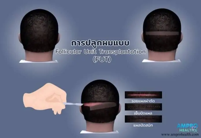 การปลูกผมแบบ Follicular Unit Transplantation (FUT) ทำครั้งเดียวสร้างเส้นผมใหม่ที่ถาวร