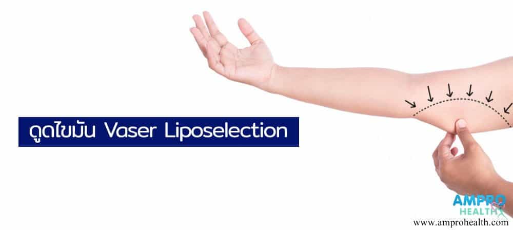 ดูดไขมัน Vaser Liposelection