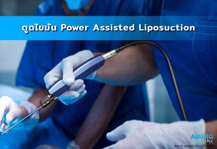 ดูดไขมัน Power Assisted Liposuction