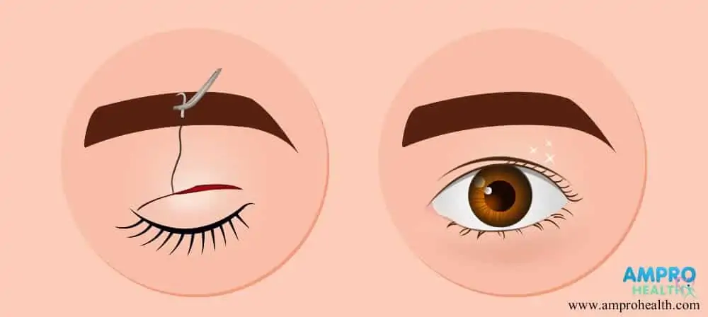 ผ่าตัดศัลยกรรมชั้นตาแบบแผลขนาดเล็ก