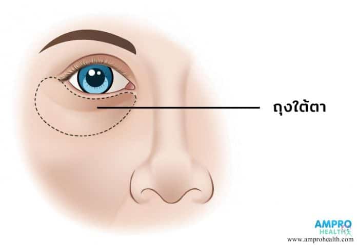 วิธีดูแลถุงใต้ตาให้สดใสไม่หมองคล้ำ