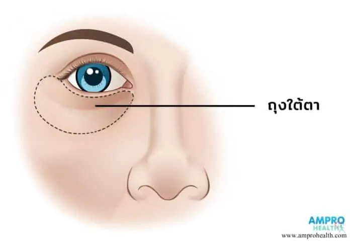 วิธีดูแลถุงใต้ตาให้สดใสไม่หมองคล้ำ