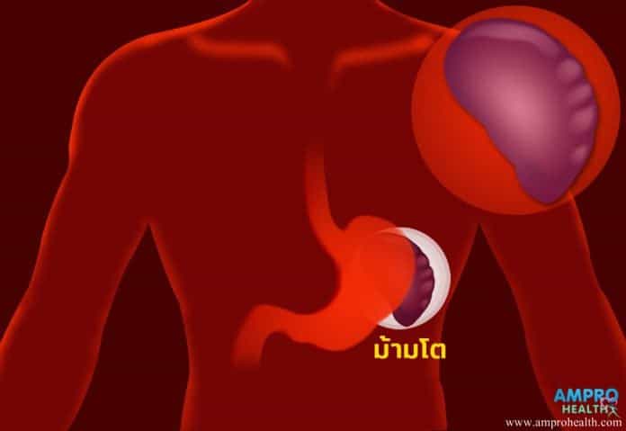 อาการม้ามโตบ่งบอกอะไร ( Splenomegaly)