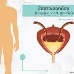 อาการปัสสาวะออกน้อย ( Oliguria and Anuria )