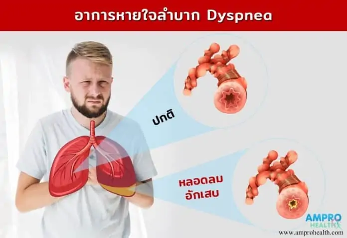 อาการหายใจลำบาก ( Dyspnea )