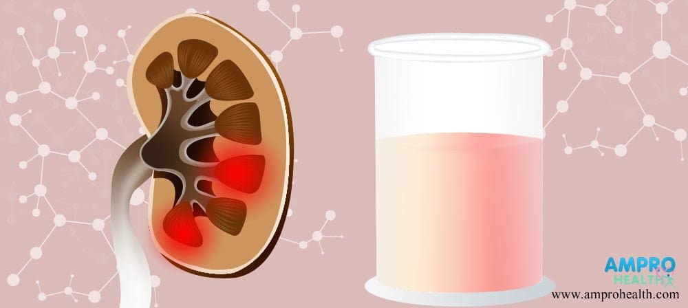 อาการปัสสาวะเป็นเลือด ( Hematuria )