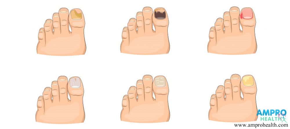 อาการของเล็บที่พบบ่อย ( Common Nail Problem )