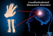 อาการร่างกายเคลื่อนไหวผิดปกติ ( Movement Disorder ) อาการร่างกายเคลื่อนไหวผิดปกติ ( Movement Disorder )