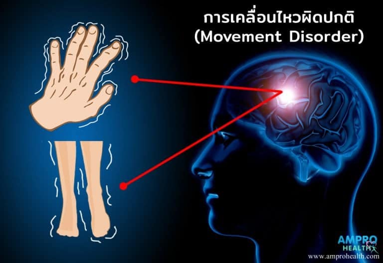 อาการร่างกายเคลื่อนไหวผิดปกติ ( Movement Disorder )